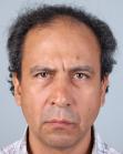 Before Hair Transplant &nbsp;Front